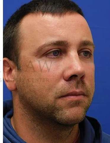Tear Trough Filler Before & After Patient #1393