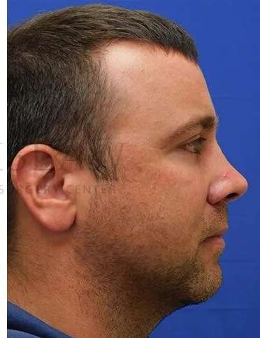 Tear Trough Filler Before & After Patient #1393