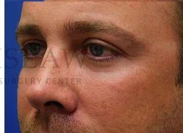 Tear Trough Filler Before & After Patient #1393