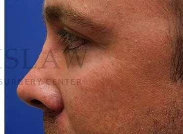 Tear Trough Filler Before & After Patient #1393