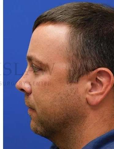 Tear Trough Filler Before & After Patient #1393