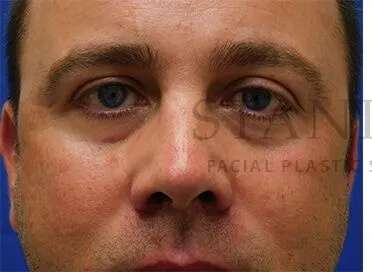 Tear Trough Filler Before & After Patient #1393