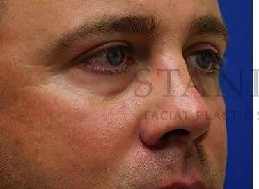 Tear Trough Filler Before & After Patient #1393