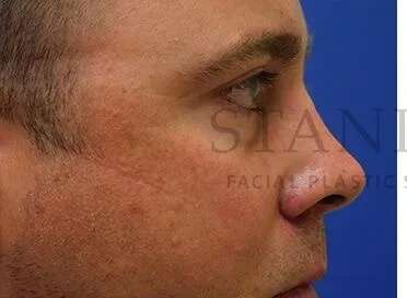 Tear Trough Filler Before & After Patient #1393