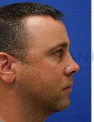 Tear Trough Filler Before & After Patient #1393