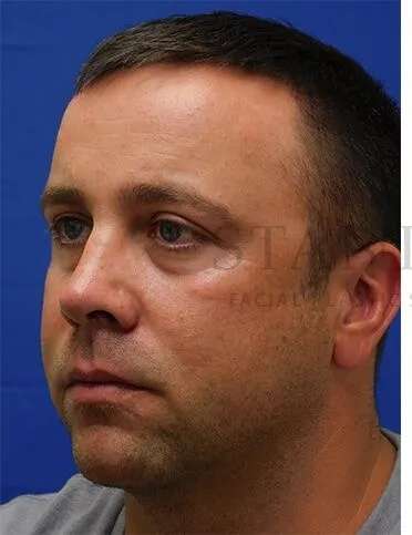 Tear Trough Filler Before & After Patient #1393
