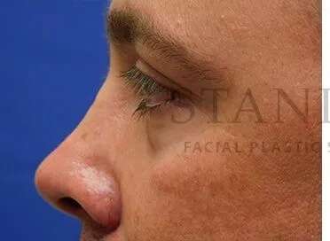 Tear Trough Filler Before & After Patient #1393
