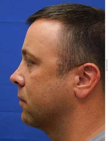Tear Trough Filler Before & After Patient #1393