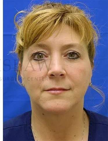 Tear Trough Filler Before & After Patient #1512