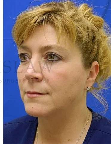 Tear Trough Filler Before & After Patient #1512