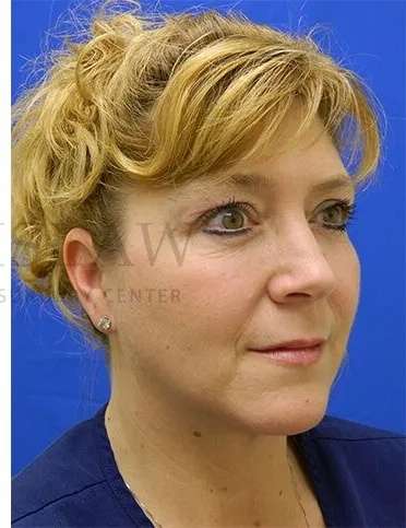 Tear Trough Filler Before & After Patient #1512
