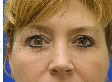 Tear Trough Filler Before & After Patient #1512