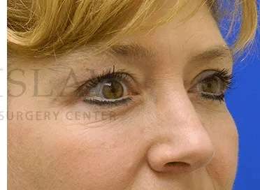 Tear Trough Filler Before & After Patient #1512