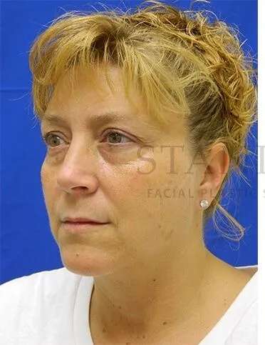 Tear Trough Filler Before & After Patient #1512