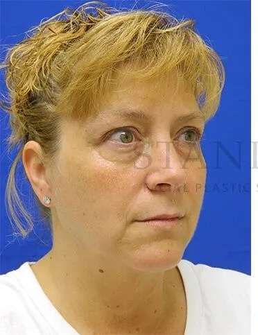 Tear Trough Filler Before & After Patient #1512