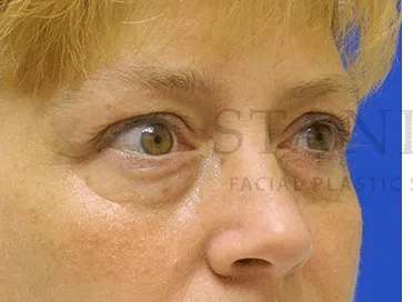 Tear Trough Filler Before & After Patient #1512
