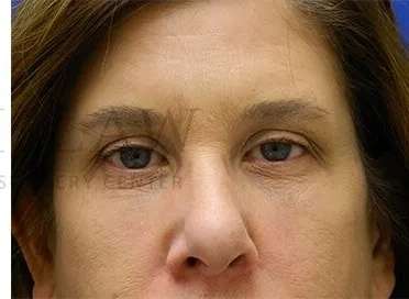 Tear Trough Filler Before & After Patient #1499