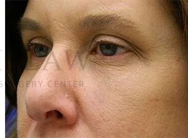 Tear Trough Filler Before & After Patient #1499