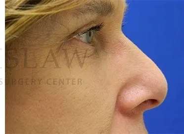 Tear Trough Filler Before & After Patient #1499