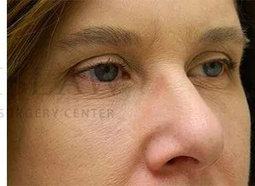 Tear Trough Filler Before & After Patient #1499