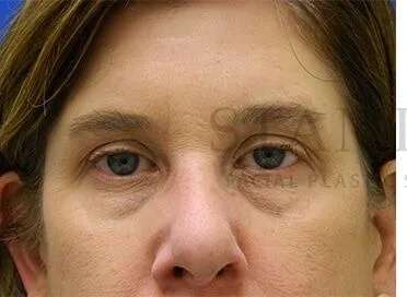 Tear Trough Filler Before & After Patient #1499