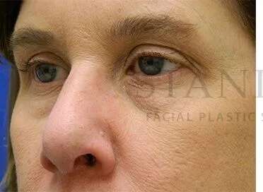 Tear Trough Filler Before & After Patient #1499