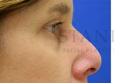 Tear Trough Filler Before & After Patient #1499
