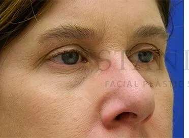 Tear Trough Filler Before & After Patient #1499