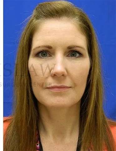 Tear Trough Filler Before & After Patient #1490