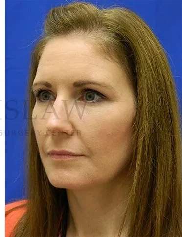 Tear Trough Filler Before & After Patient #1490