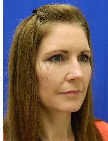 Tear Trough Filler Before & After Patient #1490