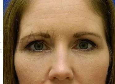 Tear Trough Filler Before & After Patient #1490