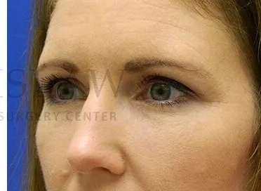 Tear Trough Filler Before & After Patient #1490