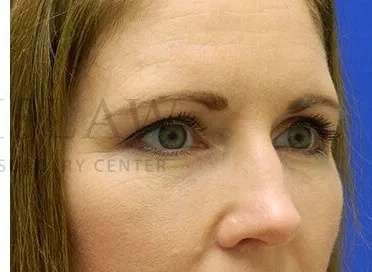 Tear Trough Filler Before & After Patient #1490