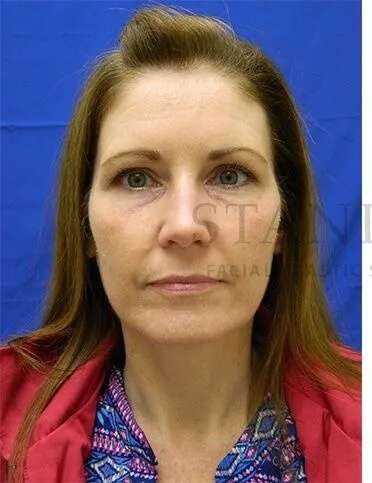 Tear Trough Filler Before & After Patient #1490