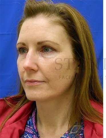 Tear Trough Filler Before & After Patient #1490