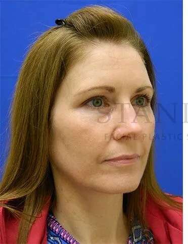 Tear Trough Filler Before & After Patient #1490