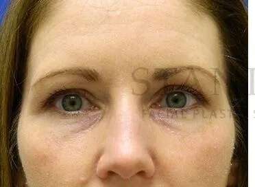 Tear Trough Filler Before & After Patient #1490