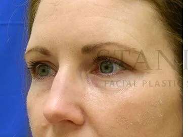 Tear Trough Filler Before & After Patient #1490