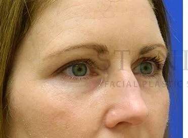 Tear Trough Filler Before & After Patient #1490