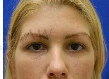 Tear Trough Filler Before & After Patient #1477