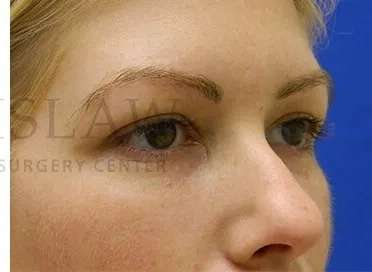 Tear Trough Filler Before & After Patient #1477