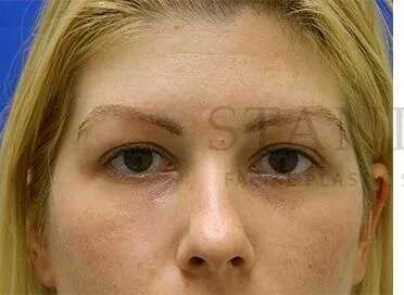 Tear Trough Filler Before & After Patient #1477