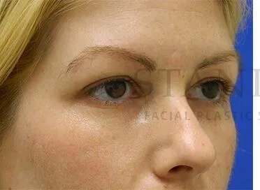 Tear Trough Filler Before & After Patient #1477