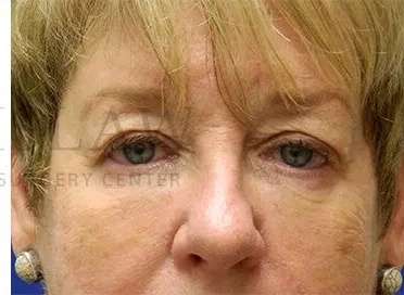 Tear Trough Filler Before & After Patient #1532