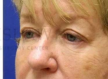 Tear Trough Filler Before & After Patient #1532