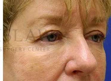 Tear Trough Filler Before & After Patient #1532