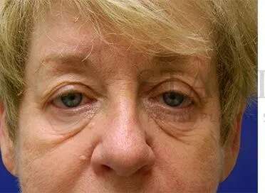 Tear Trough Filler Before & After Patient #1532
