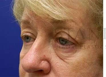 Tear Trough Filler Before & After Patient #1532