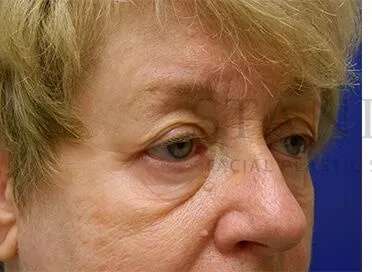 Tear Trough Filler Before & After Patient #1532